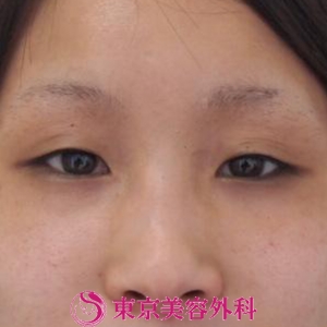 目頭切開 の症例写真 美容整形は東京美容外科