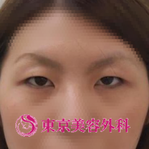 埋没法 ａｒ 重い一重瞼から末広型二重へ 美容整形は東京美容外科