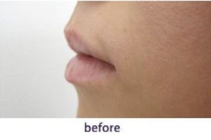 ヒアルロン酸注入 ふっくら魅力的な唇 美容整形は東京美容外科