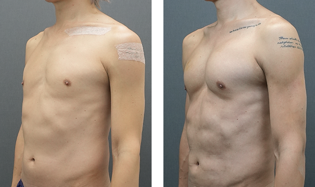 マッスルハイブリッド豊胸