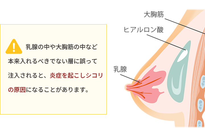 ヒアルロン酸豊胸の注入層のイメージ