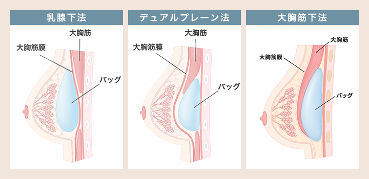 乳腺下法・大胸筋下法・デュアルプレーン法の違い