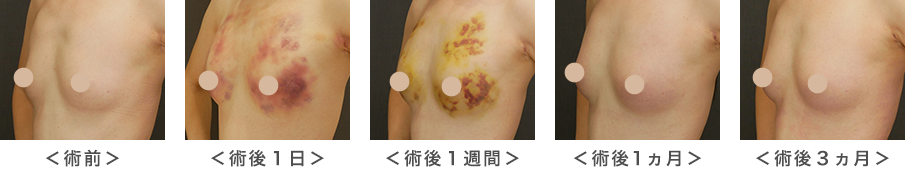 脂肪注入豊胸のバストのダウンタイム