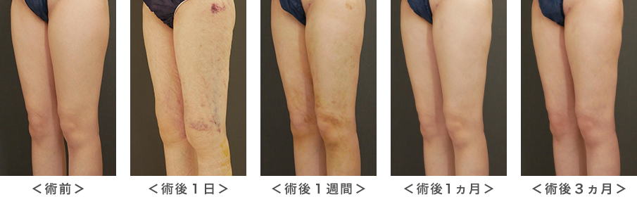 脂肪吸引部のダウンタイム