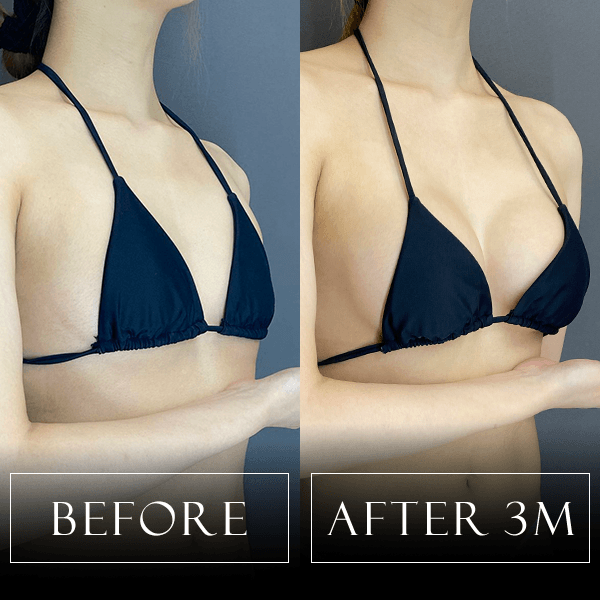 シリコンバッグ豊胸の症例写真 Before/After