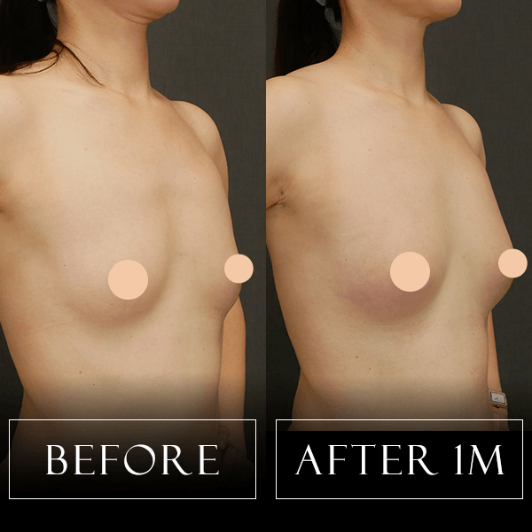 脂肪注入豊胸の症例写真 Before/After