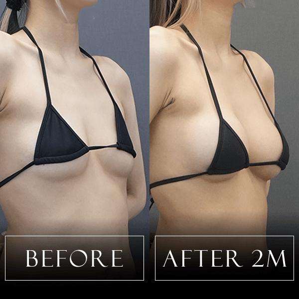 ハイブリッド豊胸の症例写真 Before/After