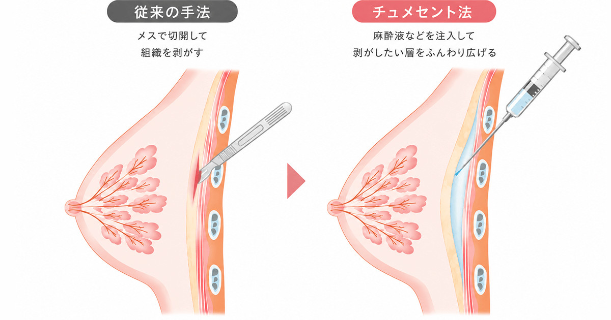東美式豊胸術の仕組み図