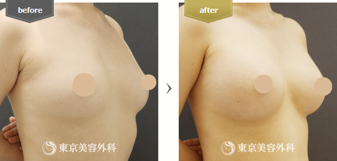 BellaGel Micro(ベラジェルマイクロ)の症例写真(斜め横)