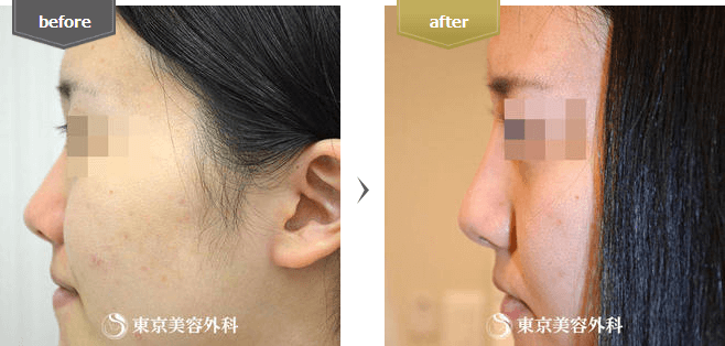 隆鼻術の症例写真(横から)