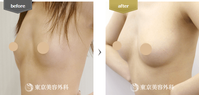 脂肪注入の症例写真(斜め横)