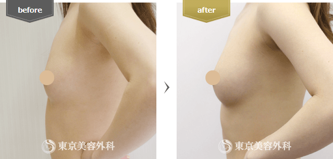 脂肪注入の症例写真(横)
