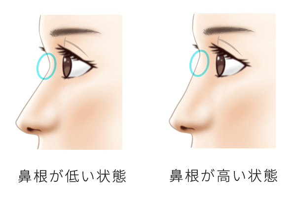 鼻根が低いと悩む方必見 理由や高くする方法について紹介 美容整形は東京美容外科