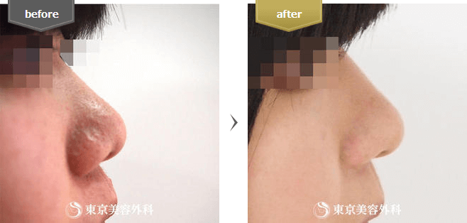 小鼻・鼻翼縮小(切開)の症例写真(横から)