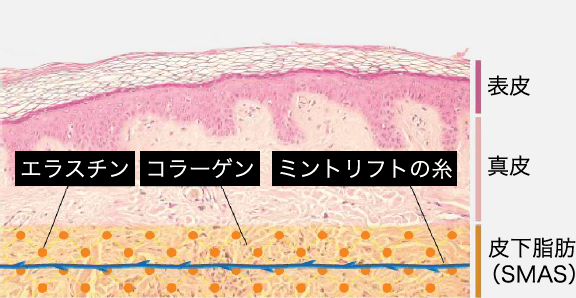 ミントリフトイメージ