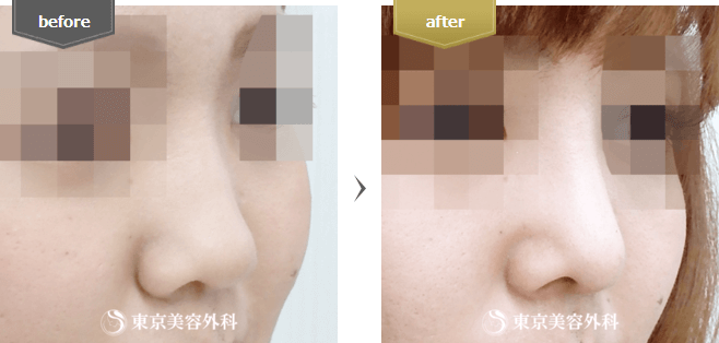 鼻中隔延長の症例写真(横から)