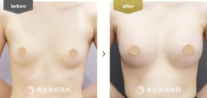 バッグ挿入(豊胸)の症例写真(正面)