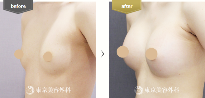 バッグ挿入(豊胸)の症例写真(横向き)