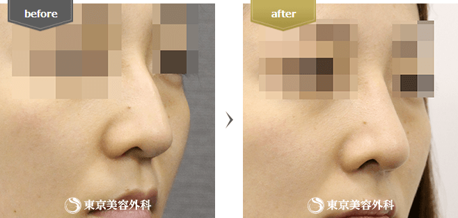 鷲鼻削りの症例写真(右横から)