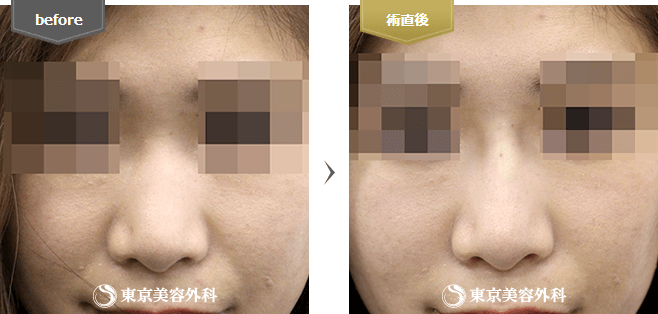 鼻ヒアルロン酸注入の症例写真(正面)