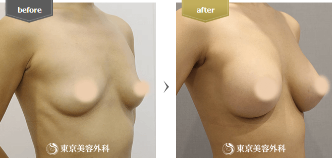 豊胸(ハイブリッド豊胸)の症例写真(斜め横)