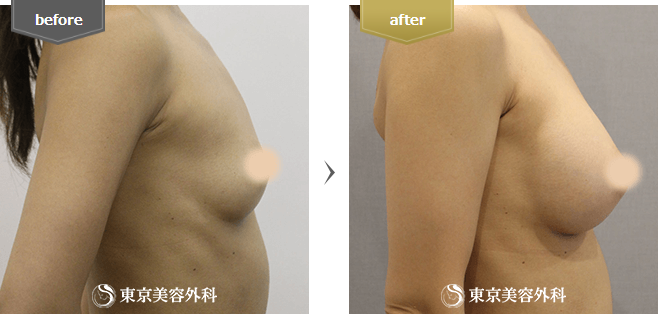 豊胸(ハイブリッド豊胸)の症例写真(横向き)