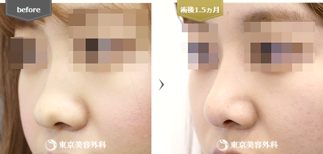 鼻尖形成の症例写真(斜め横)