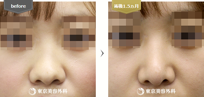鼻尖形成の症例写真(斜め横)