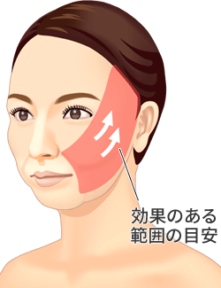フェイスリフト 美容整形は東京美容外科