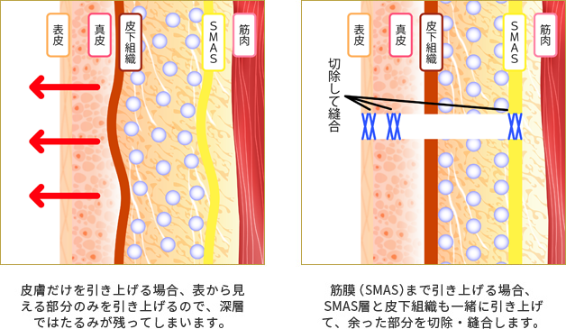 皮膚だけを引き上げる場合、表から見える部分のみを引き上げるので深層ではたるみが残ってしまいます。筋膜（SMAS）まで引き上げる場合、SMAS層と皮膚組織も一緒に引き上げて、余った部分を切除・縫合します。