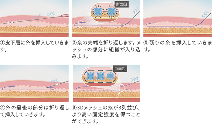 糸の入れ方