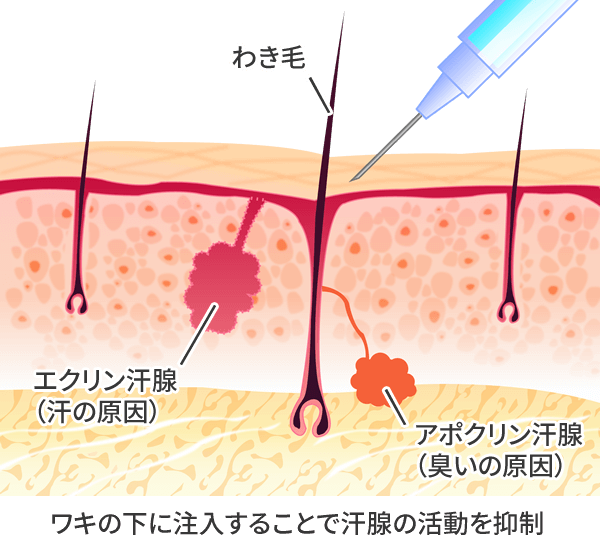 治療 ワキガ