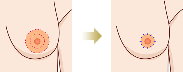 手術前と手術後の乳輪の縮小イメージ