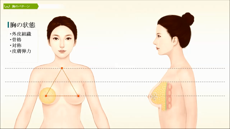 豊胸 胸の手術 胸のパターン 美容整形は東京美容外科