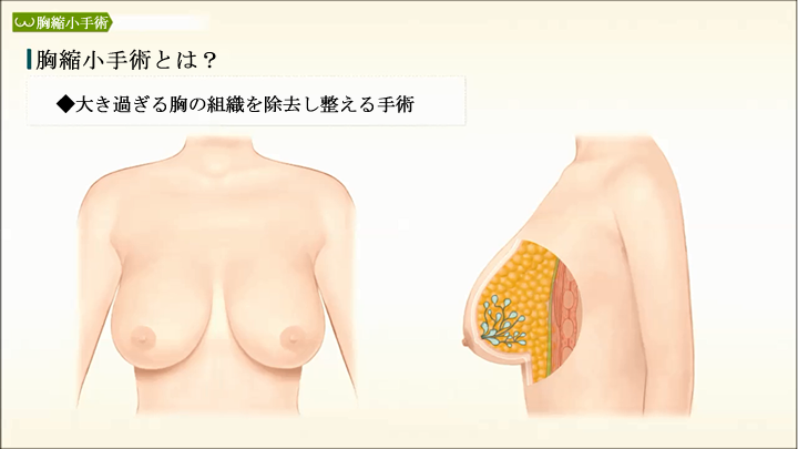 豊胸 胸の手術 胸縮小手術 美容整形は東京美容外科