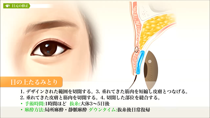 医師監修 目元の修正 目の上たるみとり 美容整形は東京美容外科