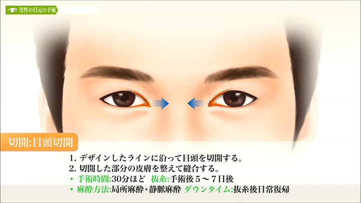医師監修 男性の目元の手術 目頭 目尻切開 美容整形は東京美容外科