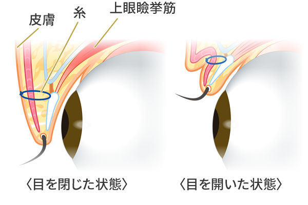 埋没法で二重まぶたになる仕組み