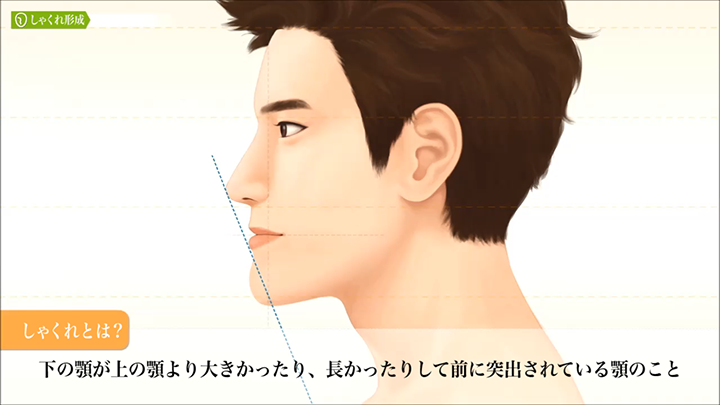医師監修 男性形成 上下顎前突 しゃくれ 美容整形は東京美容外科