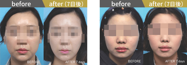 東京美容外科クリニックのBNLS注射(小顔注射)の症例写真2