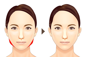 エラを削り正面顔の幅をほっそりとさせます。