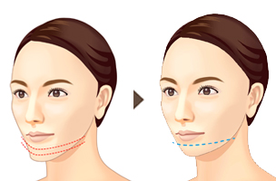 オトガイ骨切り術によるすっきりした顎イメージ