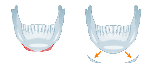 斜骨切り術により、スッとした細い顎の形成イメージ