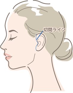 MACSリフト（ミニリフト）
