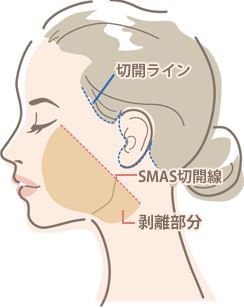 Extended Deep Plane Face and Neck Lift