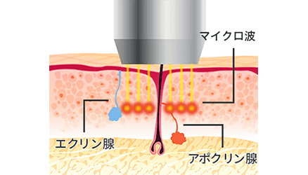 すそわきがの治療 ミラドライ 美容整形は東京美容外科 すそわきがの治療 ミラドライ 美容整形は東京美容外科