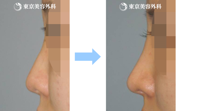 医師監修 プロテーゼによる隆鼻手術について 美容整形は東京美容外科