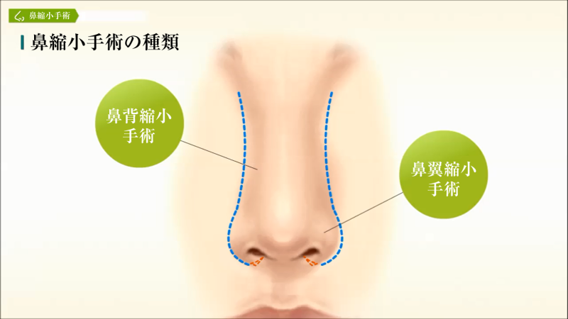 医師監修 鼻背縮小手術について 美容整形は東京美容外科
