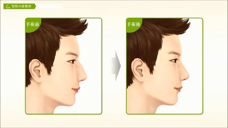 医師監修 男性の鼻整形について 美容整形は東京美容外科