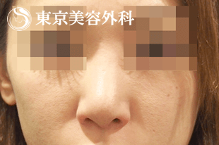 鼻中隔延長症例写真